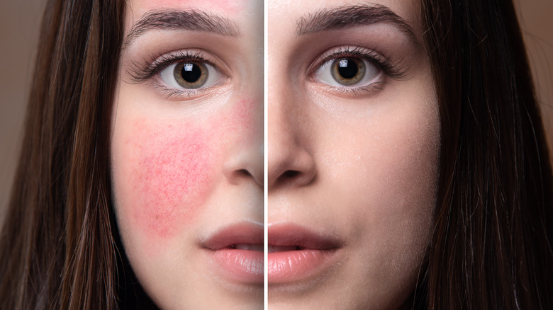 Split image of woman's face with rosacea on left side, and redness covered up on the right