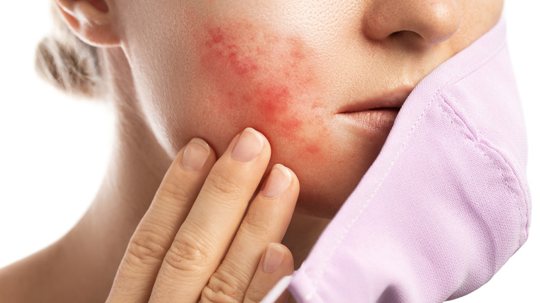 Woman with maskne, a type of acne caused by face masks