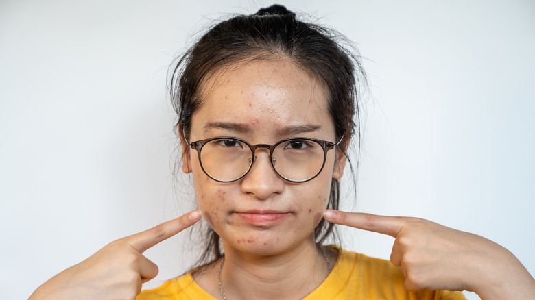 Woman pointing at acne