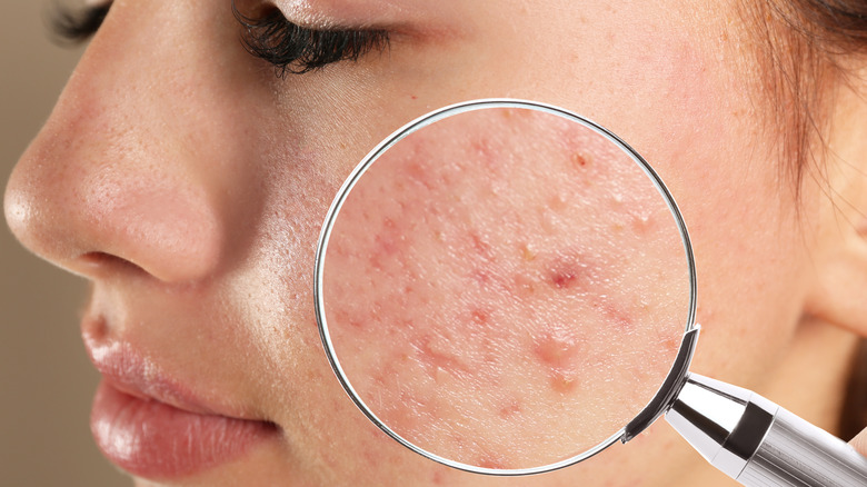 Acne scarring 