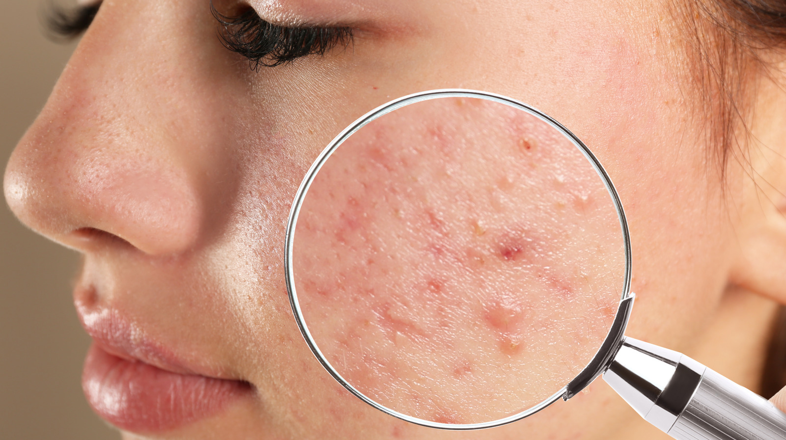 Acne Scars And Dark Spots: What Are They And How Do You Get Rid Of Them?