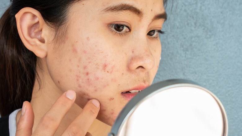 Woman with acne