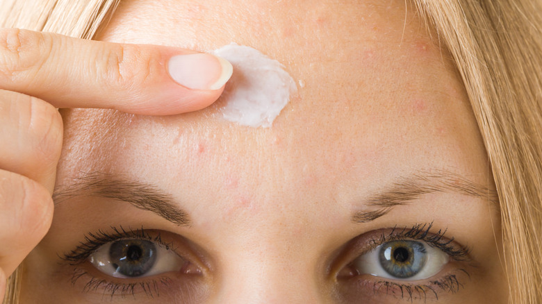 woman applying ointment to acne