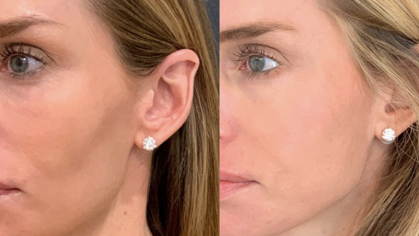 Are There Ways To Avoid The Risks Of Filler Fatigue? - 247 News Around