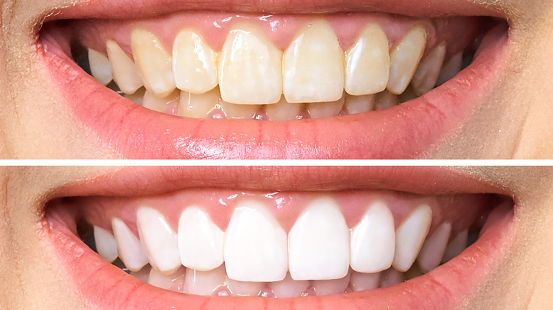 before and after tooth whitening