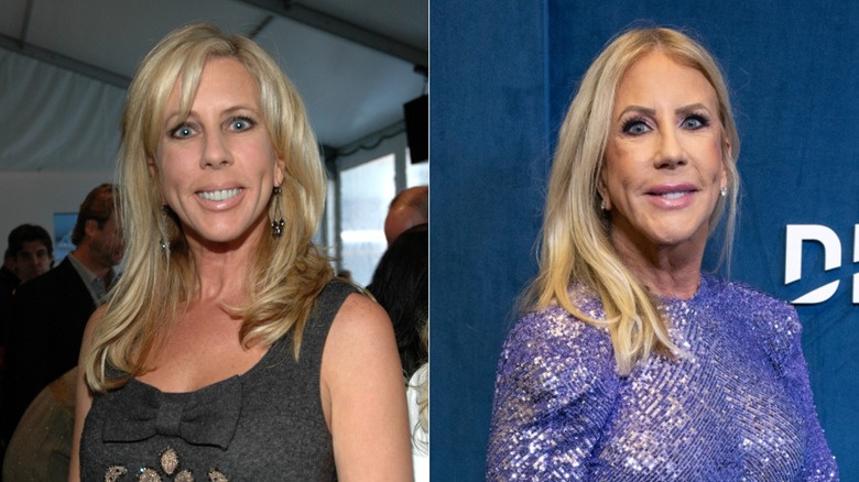 Split image of Vicki Gunvalson before and after plastic surgery