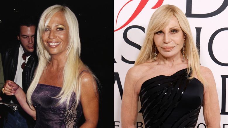 Donatella Versace before and after plastic surgery