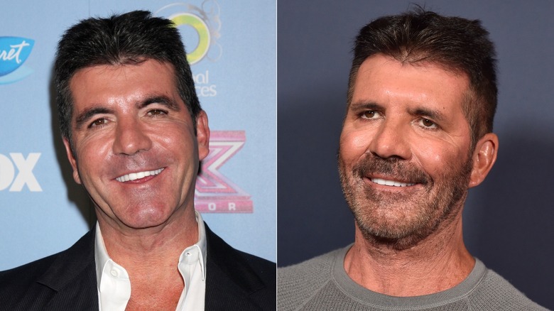 Simon Cowell before and after plastic surgery