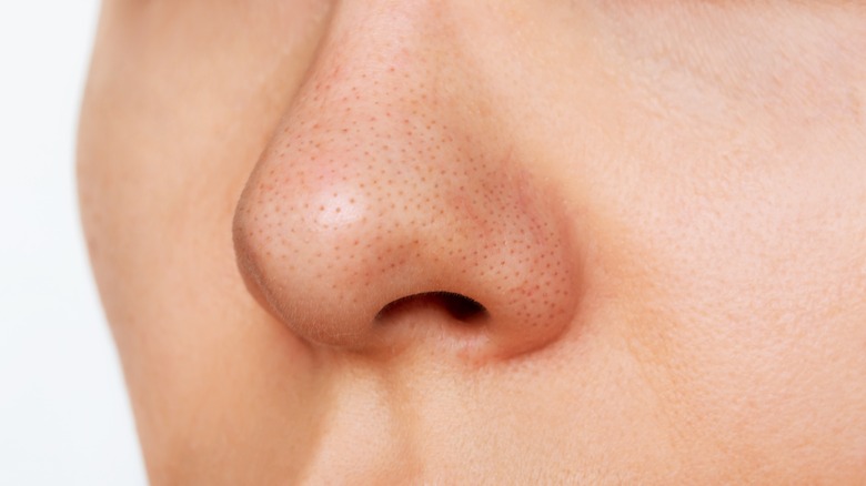 Close-up of nose with blackheads