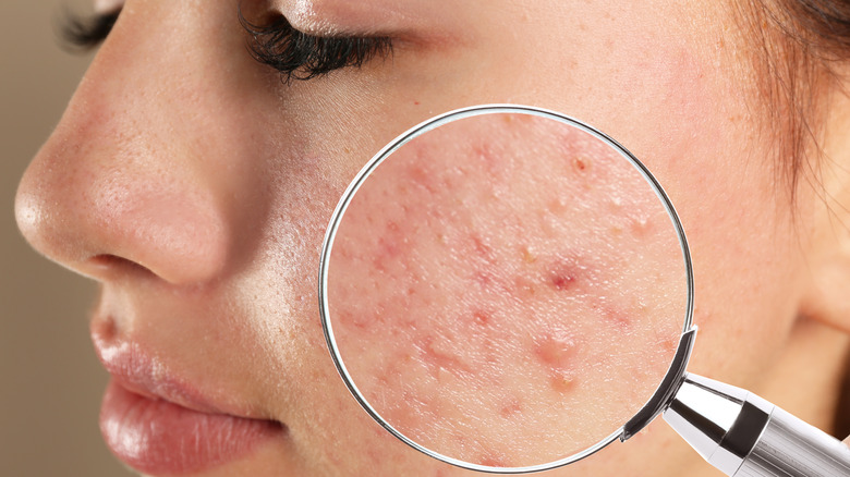 Acne on a woman's cheek 