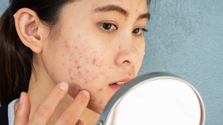 Woman with cystic acne looking into mirror