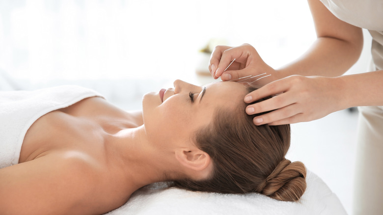 Woman getting acupuncture