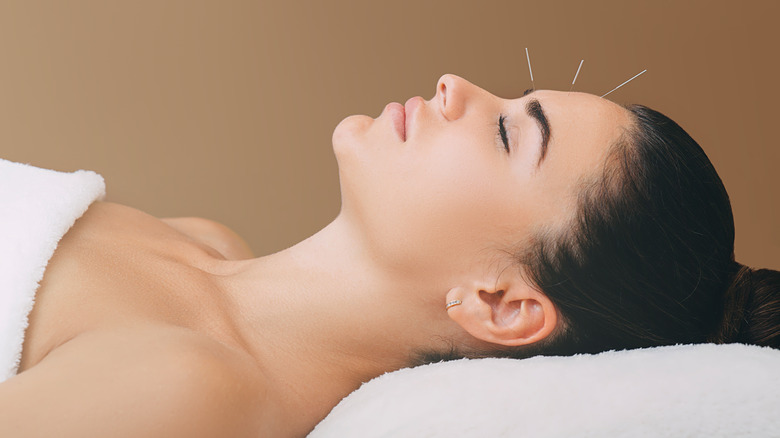 woman with acupuncture needles