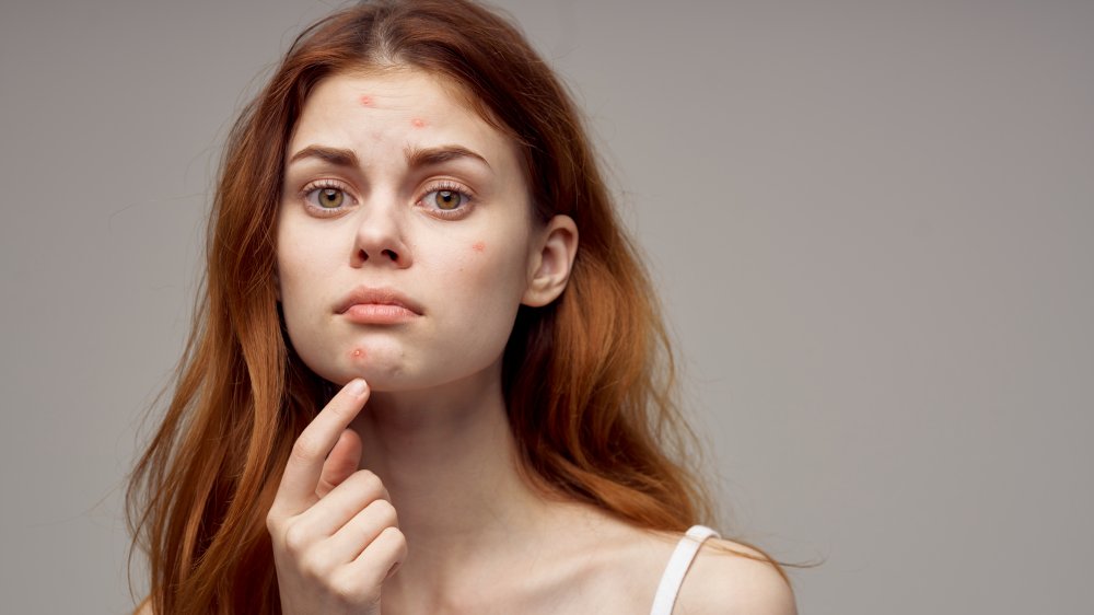 woman with acne