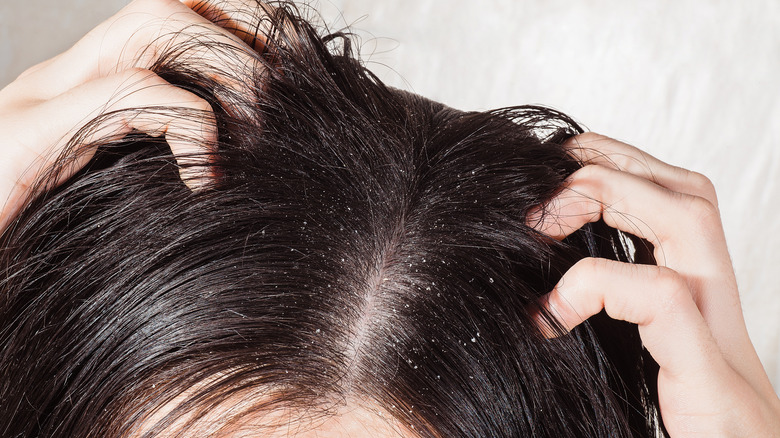 close up of dandruff on scalp and hair