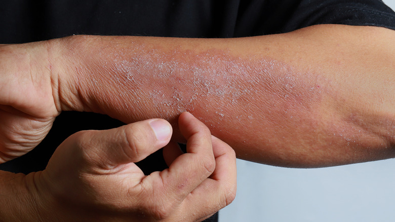 Extreme case of eczema
