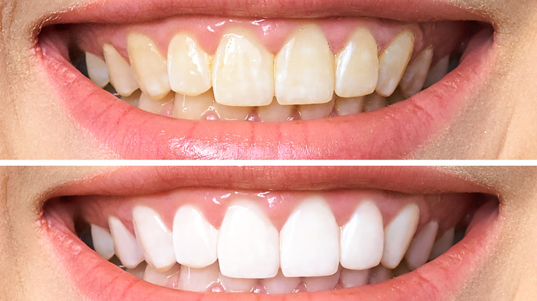En begivenhed igennem fond Can Vaseline Prevent Teeth Staining?