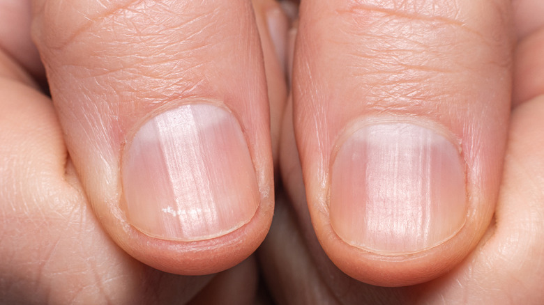 A picture of two thumbs with nails