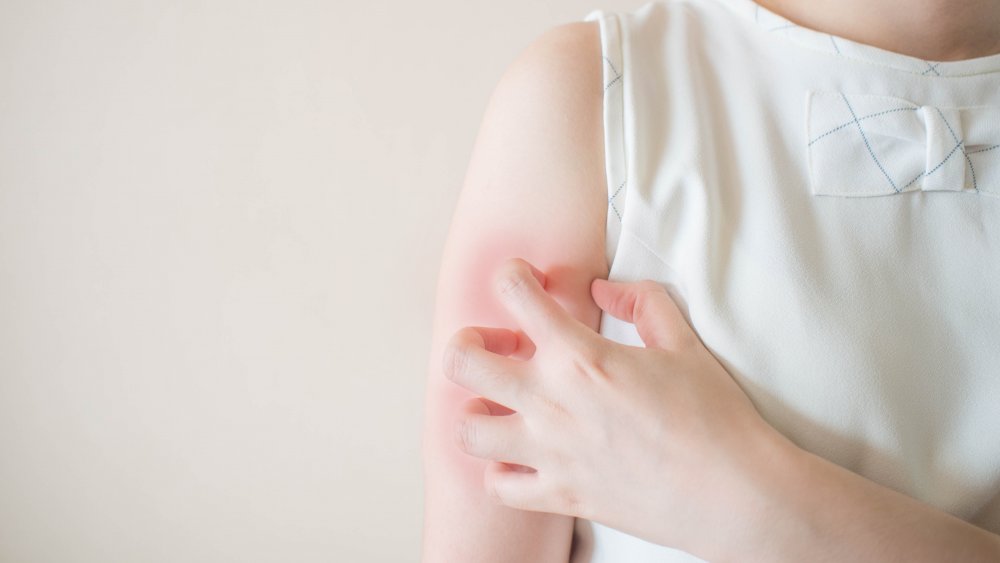 woman scratching a mosquito bite on her arm