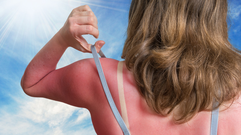 Woman with sunburnt back