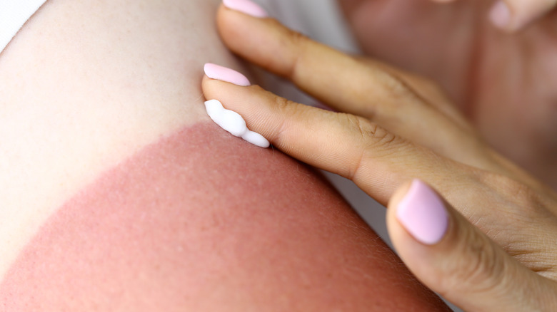 A hand applying cream to a sunburn 