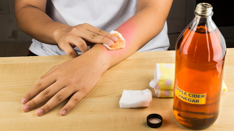 Woman using vinegar for sunburn