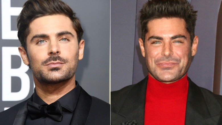 Zac Efron before and after jaw surgery