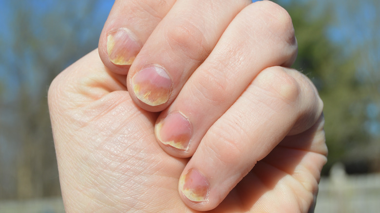 Person with nail psoriasis 