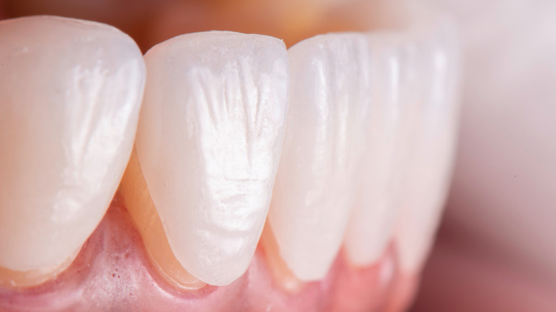 Veneer installation