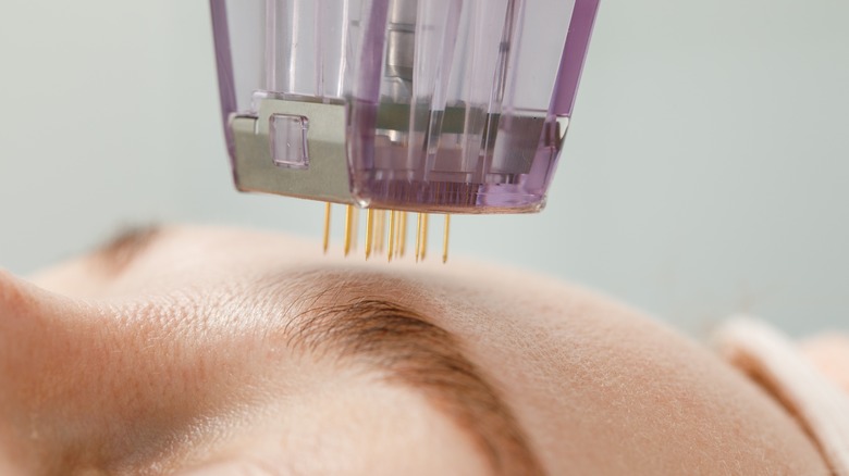 Microneedles about to puncture the skin