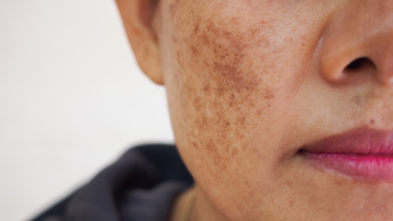 Close-up of hyperpigmentation on cheek