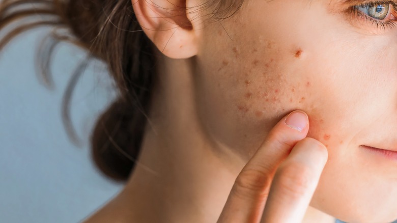 Worried woman with acne