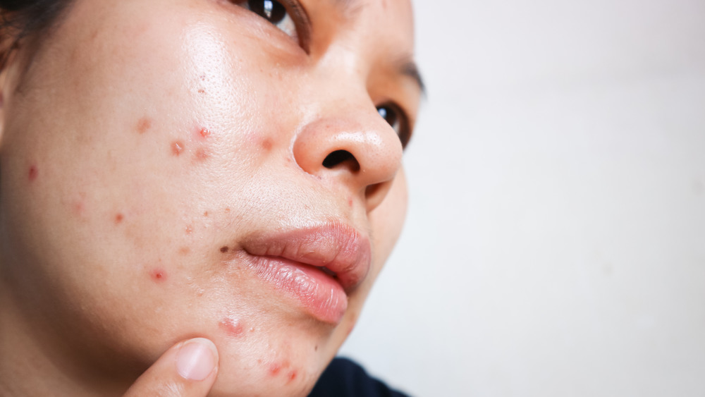 woman with acne