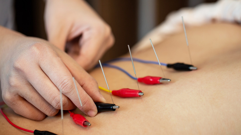 Acupuncture with electric treatment