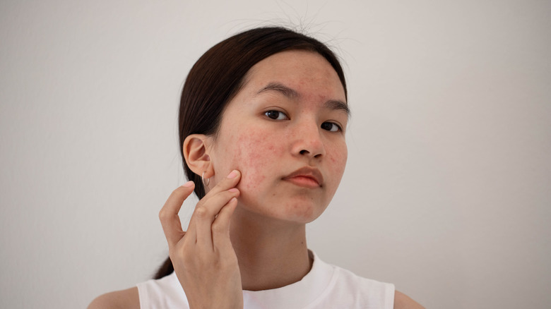 Woman with severe acne