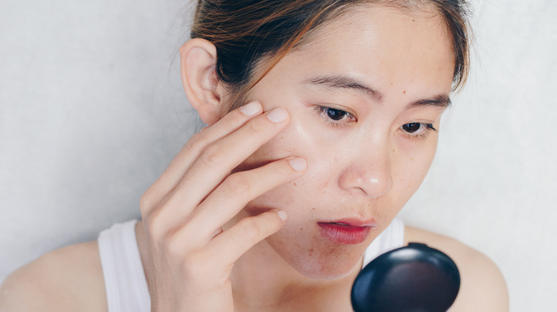 Acne scars on young woman's face