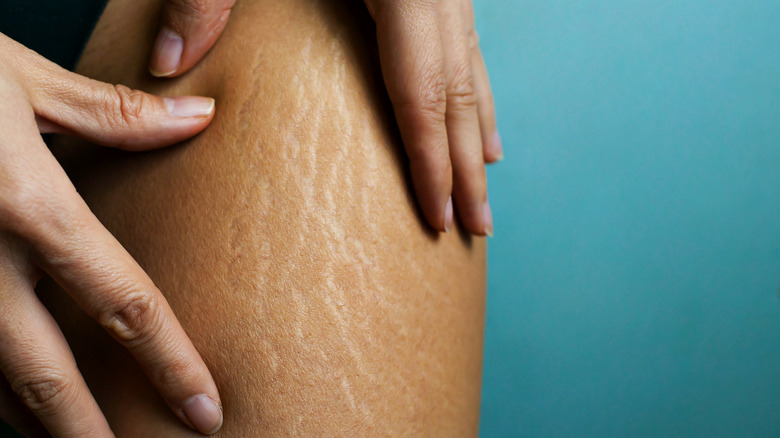 Stretch marks on woman's leg