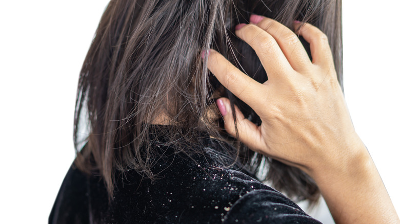 Woman scratching her head with dandruff flakes showing
