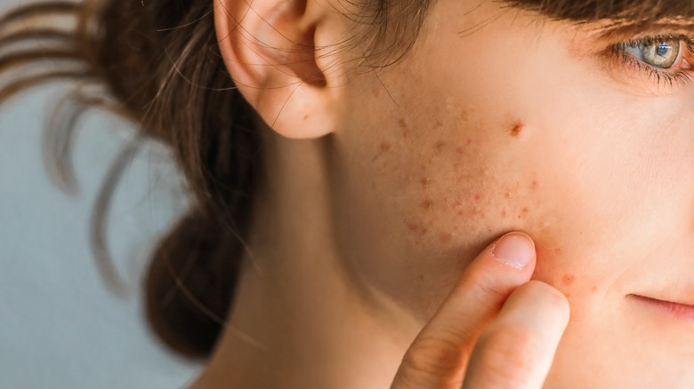 woman with breakout on face