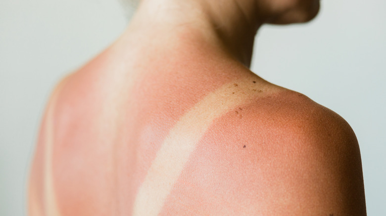 Close-up of a sunburn marks on a woman's back