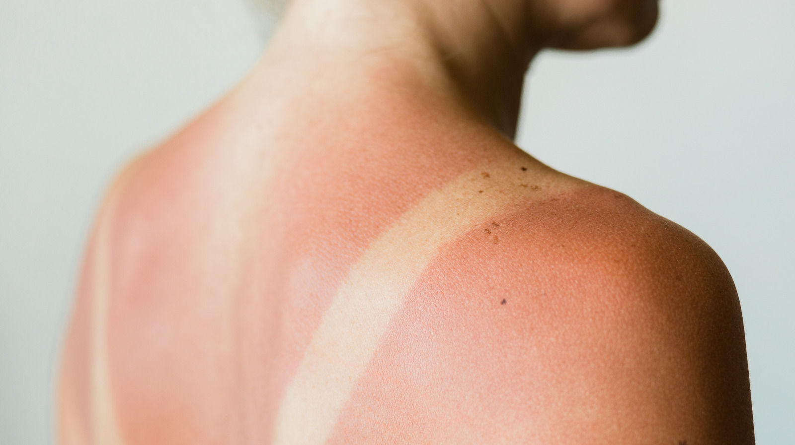 Does Oatmeal Really Help Treat Sunburn?