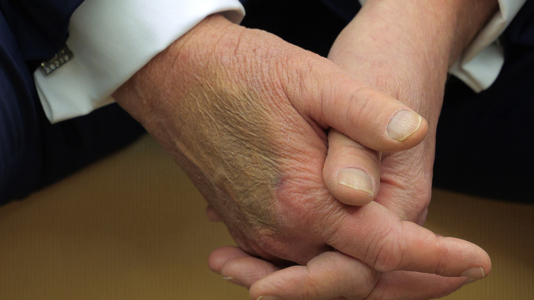 Closeup of Donald Trump's hands caked with makeup