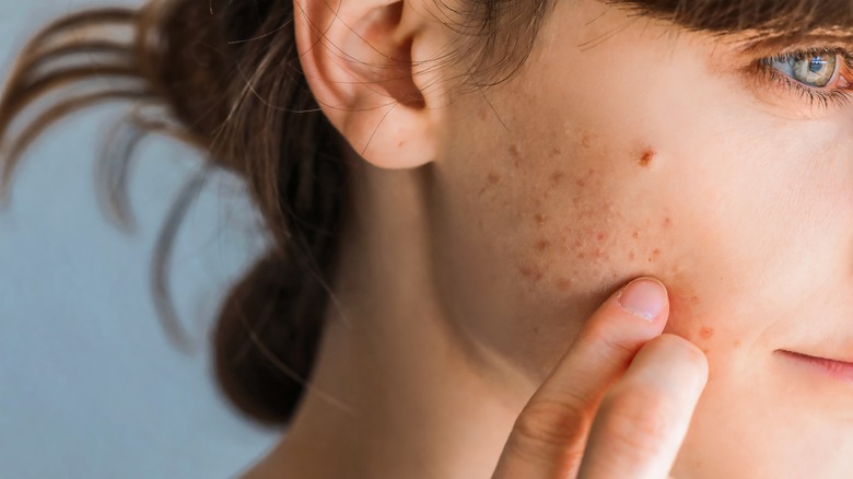 Woman with facial acne