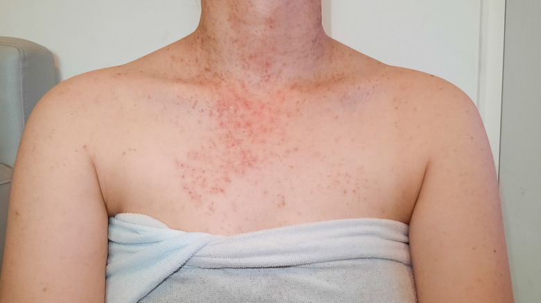 Fungal acne on chest area