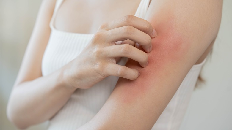 Woman with itchy rash on arm