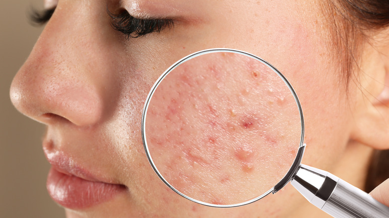 A magnifying glass over acne and scars on a woman's face 