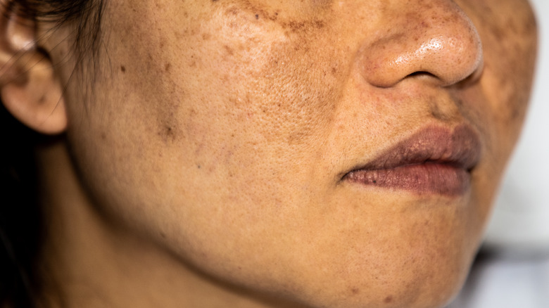 Woman with hyperpigmentation