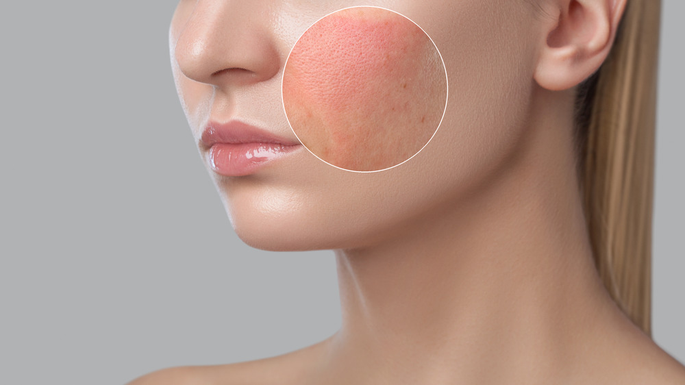 Woman with rosacea