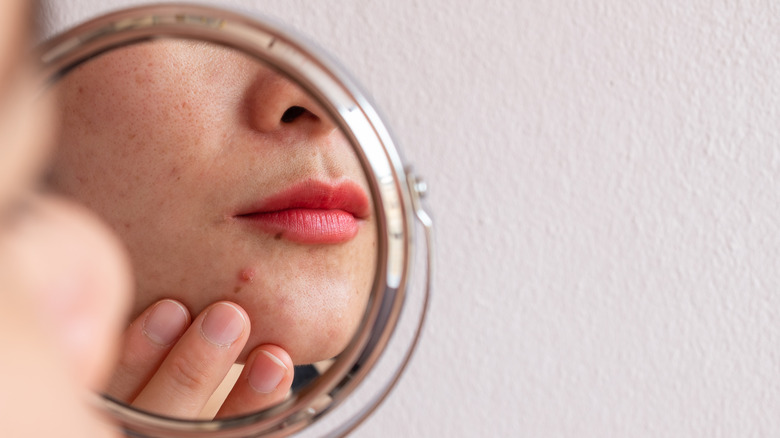 woman with acne