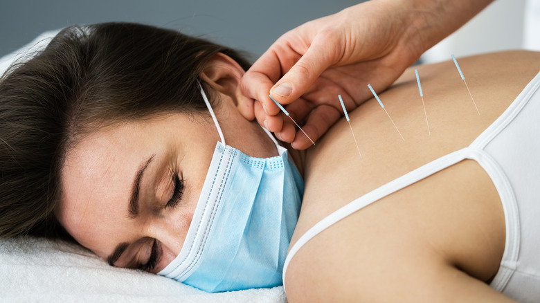 Inserting acupuncture needles